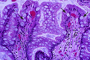 Metaplasia intestinal e displasia